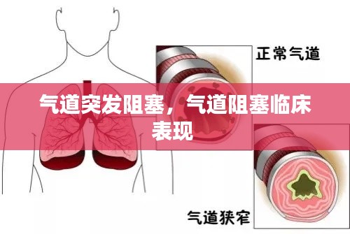 气道突发阻塞,气道阻塞临床表现
